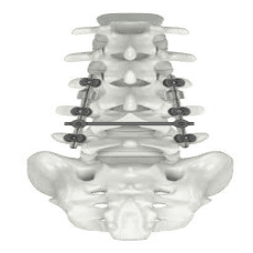 Hệ thống nẹp vít cột sống lưng -  CTS 5.5 Posterior pedicle screw system