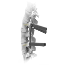 Hệ thống bắt vít qua da cột sống lưng - CTS-5.5 MIS Hollow Pedicle Screw Multi Axial